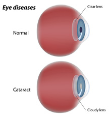 cataract eye