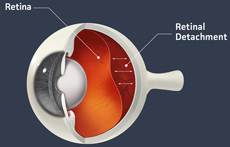 retinal detachment drawing