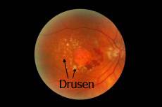 Drusen