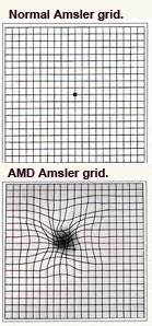 Amsler grids