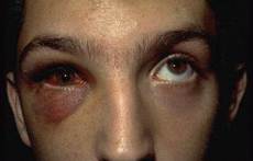 ojo con fractura obitraria