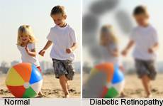 Sichtfeld bei diabetischer Retinopathie