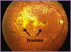 drusen