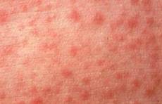 measles rash