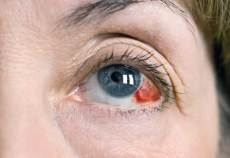 subjunctival hemorrhage